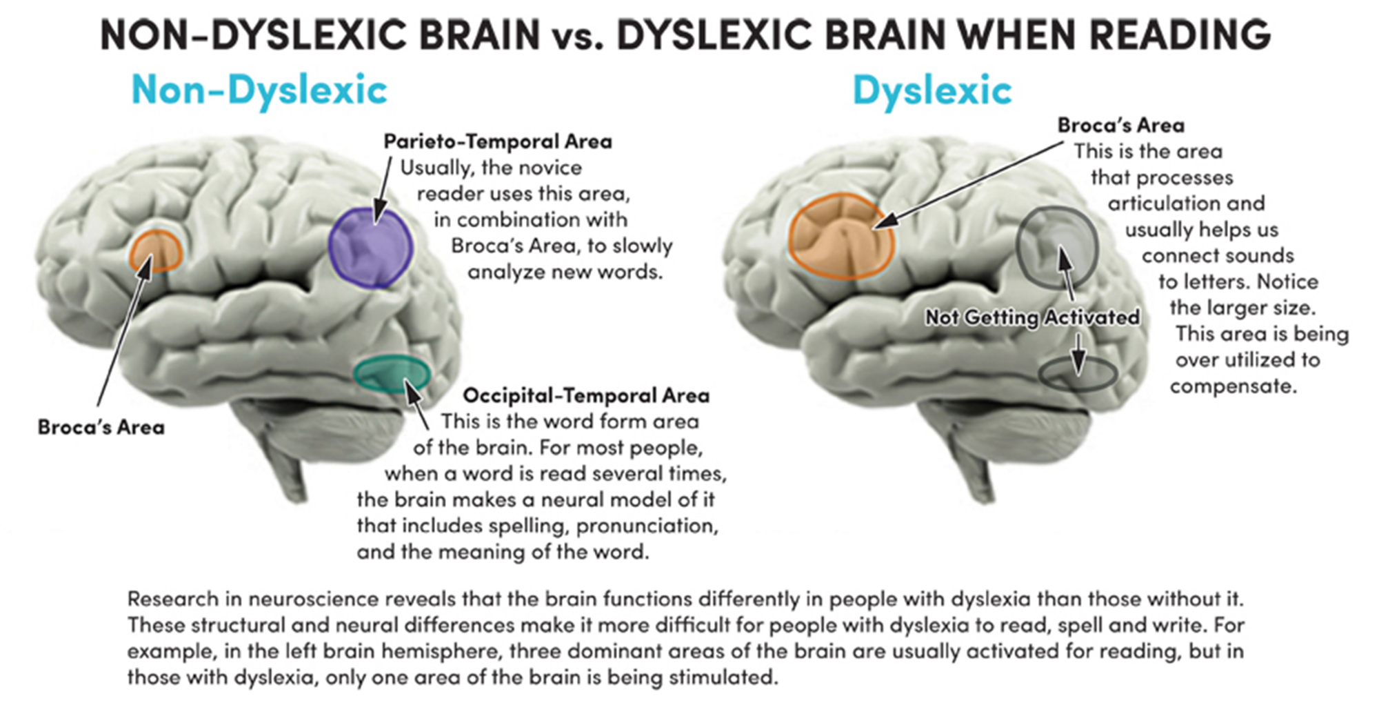 brain dyslexia